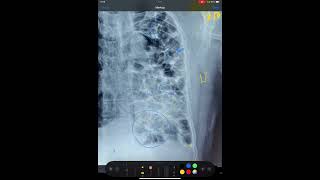 BRONCHIECTASIS FIBROSIS OF LUNGS MEDIASTINAL SHIFT X RAY CHEST [upl. by Fitzhugh]