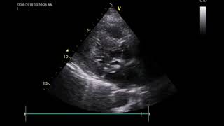 Mitral Valve Vegetation  Posterior Mitral Leaflet PML [upl. by Akenom422]