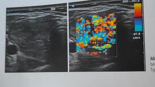 Facharztprüfung Innere Medizin Morbus Basedow [upl. by Lucy]