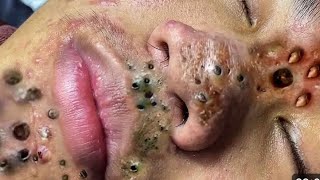 Satisfying with a big blackheads viralvideo blackheads acnetreatment nasa videoshort foryou [upl. by Becket]