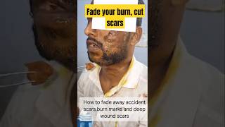 Fade yourscars accidentburn skincare love cream ointment trending foryou reels drsuhina [upl. by Bengt]