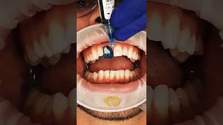 Composite bonding step by stepdentaldoubts kissdentalYT smilemakeover smile teethwhitening [upl. by Ordnas]