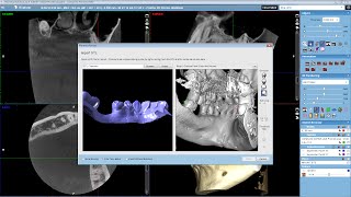 Overlaying an STL file with a CBCT volume [upl. by Claudie]