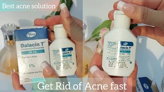 How to get rid of acne fast  Dalacin T lotion Review Clindamycin [upl. by Arhas92]