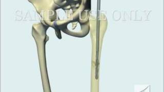 Femoral Fracture Fixation Surgery Intramedullary Nail [upl. by Baryram741]