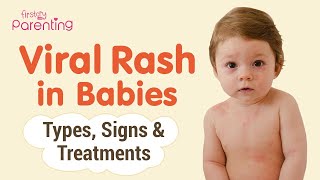 Common Viral Rashes in Babies  Types Signs and Treatement [upl. by Aveneg]