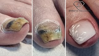 Bruised toe nail transformation Pedicure Removing bruised toe nail doing faded french extension [upl. by Cosmo389]