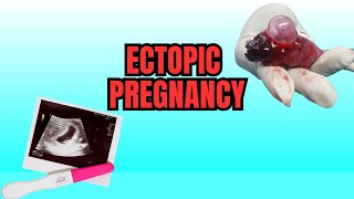 Ectopic Pregnancy  Causes Symptoms And Risks [upl. by Elem]