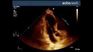 EchoWeb  Left Ventricular Akinesis [upl. by Alano372]