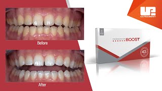 What to Expect with Opalescence Boost Professional Teeth Whitening [upl. by Anilatsyrc698]