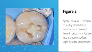 Indirect Pulp Capping Case using TheraCal LC [upl. by Profant]