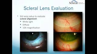 Scleral Lenses Basic to Advanced Troubleshooting [upl. by Aminta743]