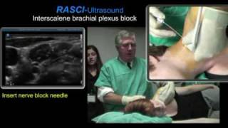 Ultrasound guided interscalene brachial plexus block [upl. by Ettenuahs486]