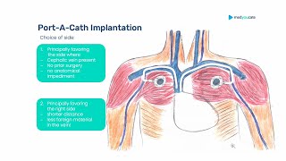 Peripheral amp Central Venous Access  CVC PortACath Hickman amp Co [upl. by Ydaj]