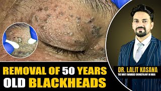 REMOVAL OF 50 YEARS OLD BLACKHEADS II Dr Lalit Kasanas [upl. by Seraphine]