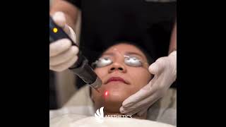 PicoSure Laser Treatment [upl. by Addam965]