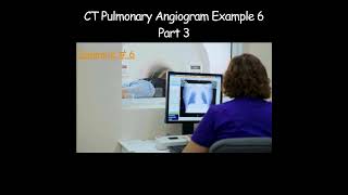 CT Pulmonary Angiogram  Example 6  Part 3 radiologist radiology angiogram artefact [upl. by Stormy]