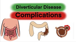 Complications of Diverticular Disease [upl. by Araic]