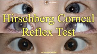 Hirschberg Corneal Reflex Test Principles and Procedure [upl. by Nuawd]