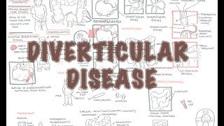 Diverticular Disease diverticulitis  Overview [upl. by Lirva]