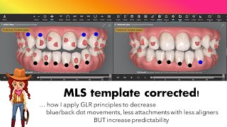 Invisalign ClinCheck  MLS vs GLR templates [upl. by Clemence]