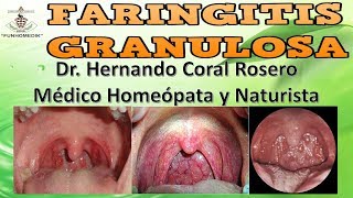 FARINGITIS GRANULOSA  INFLAMACIÓN DE LA FARINGE CON PERI ADENITIS COLORACIÓN ROJIZA [upl. by Naelcm]