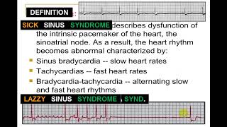 EKG SICK SINUS SYNDROME [upl. by Kcirddec618]