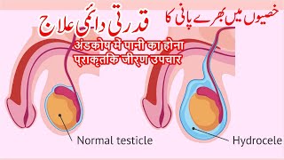 Get Permanant Relief from Hydrocele  Natural Treatment of Hydrocele [upl. by Trik]