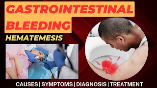 Upper Gastrointestinal Bleeding  Upper GI Bleeding  GI Bleeding  Hematemesis [upl. by Hopkins]