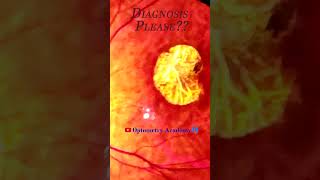 Central Areolar Choroidal Dystrophy  Macular Pathology  macular scar  Retina  Short Video 77 [upl. by Connel]