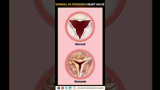 Normal vs Narrowed Stenosed Heart Valve education neet biology heart [upl. by Glaser]