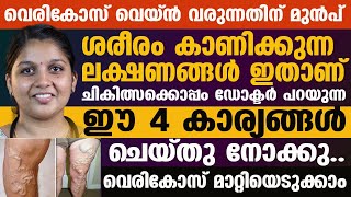 വെരികോസ് വെയ്ൻ ചികിത്സക്കൊപ്പം ഡോക്ടർ പറയുന്ന ഈ 4 കാര്യങ്ങൾ ചെയ്തു നോക്കു വെരികോസ് മാറ്റിയെടുക്കാം [upl. by Sessylu]