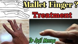 mallet finger treatment  mallet finger treatment at home  mallet finger exercises  in hindi [upl. by Ob293]