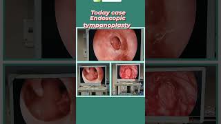 13 November 2024 Large EAR 👂 DRUM perforation repairtympanoplastyendoscopic ear 👂 surgery [upl. by Kliman973]