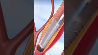 Angioplasty procedure animation shortsheartattackcardiac surgerystentbypass [upl. by Anirtruc560]