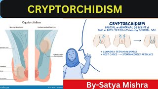 Cryptorchidism  Nursing Classes  Pediatric Nursing  Easy Explanation in Hindi [upl. by Naryt]