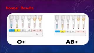 ABO discrepancy and transfusion practice part one By Dr Mohamed Samir [upl. by Rita]