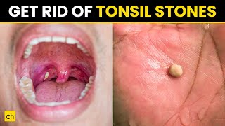 How to Prevent Tonsil Stones  Try 10 Ways  Credihealth tonsilitis tonsils [upl. by Eilhsa]