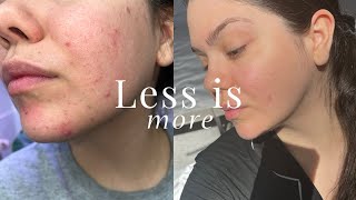 NOT Having a Skincare Routine Saved My Skin [upl. by Einnok675]