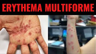 ERYTHEMA MULTIFORME  Triggers Symptoms Diagnosis Treatment  What is Erythema multiforme [upl. by Favata]