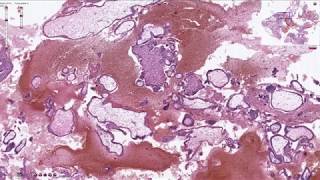 Products of Conception  Histopathology [upl. by Ellednahs]