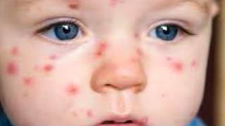 What is chickenpox Signs and symptoms of chickenpox [upl. by Jak]