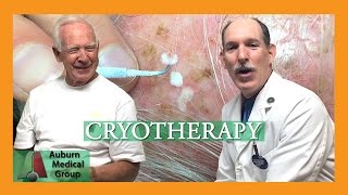 Actinic Keratosis Frozen with Cryotherapy  Auburn Medical Group [upl. by Ittam]