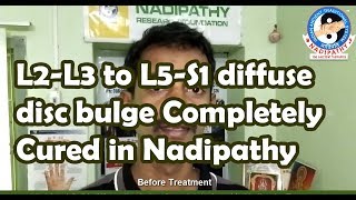 L2L3 to L5S1 diffuse disc bulge Completely Cured in Nadipathy Treatment [upl. by Paugh]