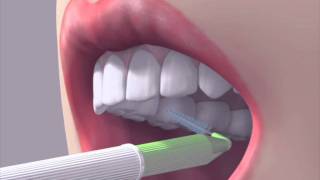 How to use an interdental brush [upl. by Avert877]