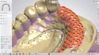 3Shape Dental System Removable Partial Framework Design and SLM Production with Tim Bertram [upl. by Georgette]