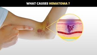 Hematomas Causes Symptoms Solutions [upl. by Malinowski770]