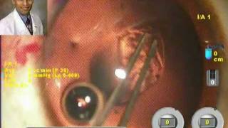 AcrySof Toric IOL Implantation in Anterior Lenticonus in a 15 yr Child Dr Suresh Pandey Suvi Kota [upl. by Esinahs]