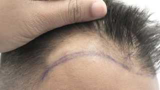 FUE by Dr Raghu Reddy  Norwood 2 hair loss [upl. by Nnyleve612]