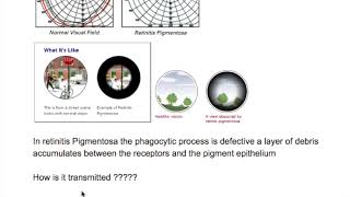 Retinitis Pigmentosa [upl. by Teage]